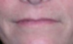 Lip Extension Surgery