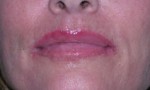 Lip Extension Surgery