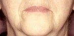Lip Extension Surgery
