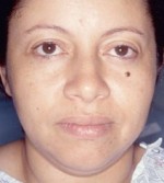 Facial Liposculpture
