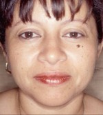 Facial Liposculpture