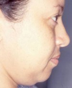Facial Liposculpture