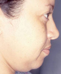 Facial Liposculpture Before and After Photos | Dr. Balakhani