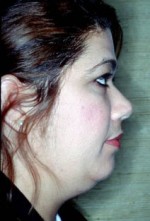 Facial Liposculpture