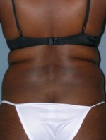 Body Liposculpture