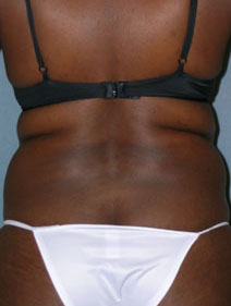 Body Liposculpture Before and After Photos
