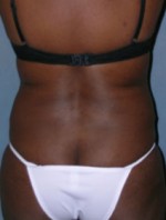 Body Liposculpture