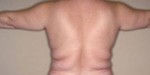 Body Liposculpture