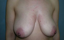 Mastopexy Augmentation Before and After Photos