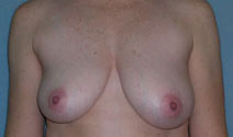 Mastopexy Augmentation Before and After Photos