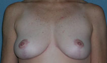 Mastopexy Augmentation Before and After Photos