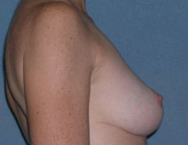 Mastopexy Augmentation Before and After Photos