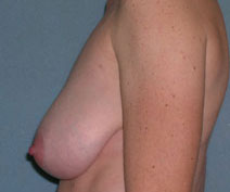 Mastopexy Augmentation Before and After Photos