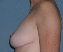 Mastopexy Augmentation Before and After Photos