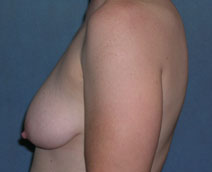 Mastopexy Augmentation Before and After Photos