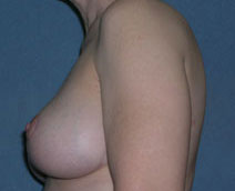 Mastopexy Augmentation Before and After Photos