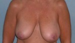 Mastopexy Augmentation