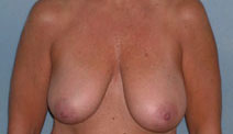 Mastopexy Augmentation Before and After Photos