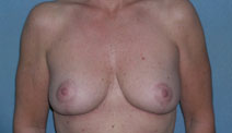 Mastopexy Augmentation Before and After Photos