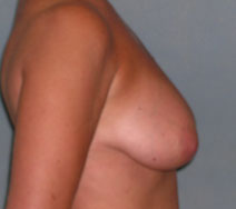 Mastopexy Augmentation Before and After Photos