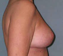 Mastopexy Augmentation Before and After Photos