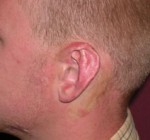 Otoplasty
