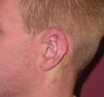 Otoplasty