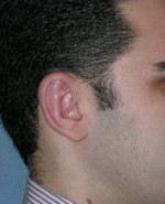 Otoplasty