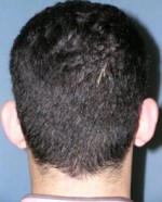 Otoplasty