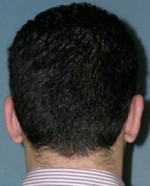 Otoplasty
