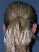 Otoplasty