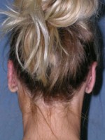 Otoplasty