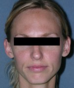 Otoplasty