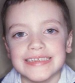 Otoplasty