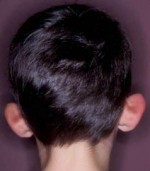 Otoplasty