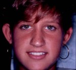 Otoplasty