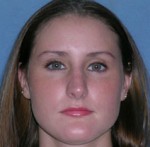 Rhinoplasty