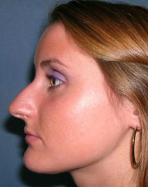 Rhinoplasty Before and After Photos | Dr. Balakhani