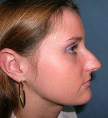 Rhinoplasty Before and After Photos | Dr. Balakhani