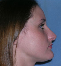 Rhinoplasty Before and After Photos | Dr. Balakhani