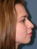 Rhinoplasty