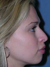 Rhinoplasty Before and After Photos | Dr. Balakhani