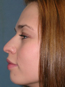 Rhinoplasty Before and After Photos | Dr. Balakhani