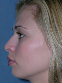 Rhinoplasty Before and After Photos | Dr. Balakhani