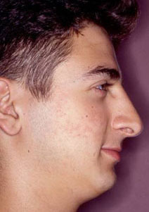 Rhinoplasty Before and After Photos | Dr. Balakhani