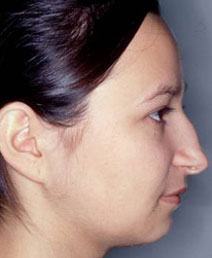 Rhinoplasty Before and After Photos | Dr. Balakhani