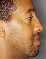 Rhinoplasty