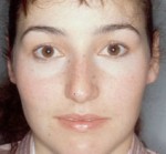 Rhinoplasty