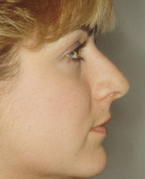 Rhinoplasty Before and After Photos | Dr. Balakhani