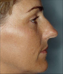 Rhinoplasty Before and After Photos | Dr. Balakhani